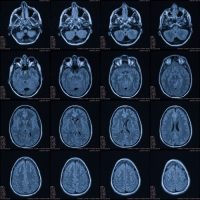 TIME IS BRAIN The Importance of Rapidly Responding To Stroke Symptoms