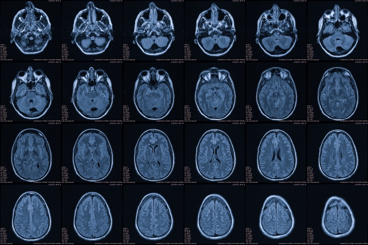 TIME IS BRAIN The Importance of Rapidly Responding To Stroke Symptoms